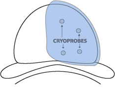 cryo4