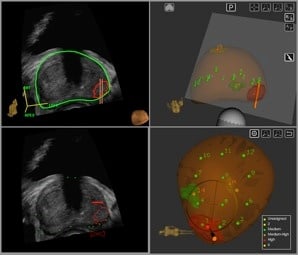 MRI-ultrasound-fusion-process-illustration