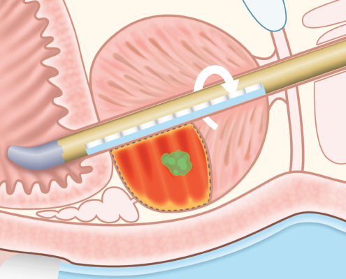 New Treatment for Prostate Cancer and BPH